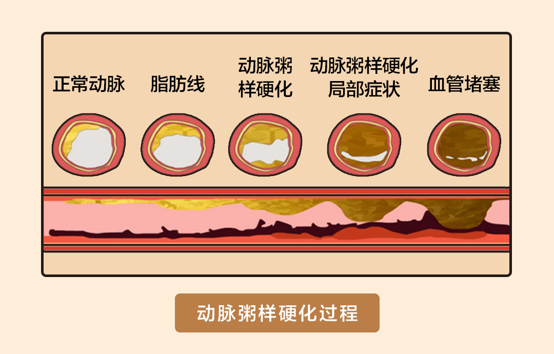 此类饮食方式容易导致胆固醇和血脂附着于血管壁上,造成动脉硬化,血管