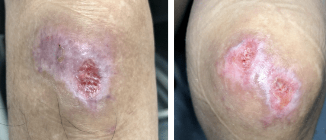 皮肤伤口包扎vs暴露如何选一个案例教你掌握