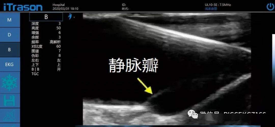 picc置管中如何区分动静脉