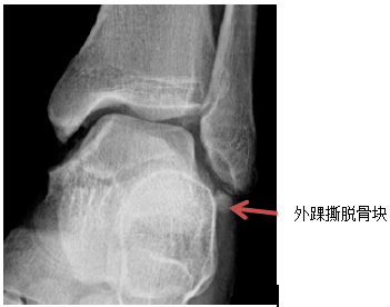 脚踝骨折病例单图片图片