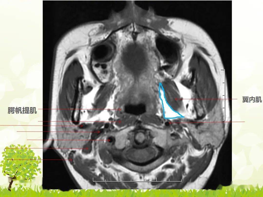 咽旁间隙解剖及常见病变影像表现