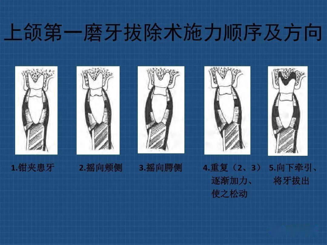 上下颌多根牙分根法