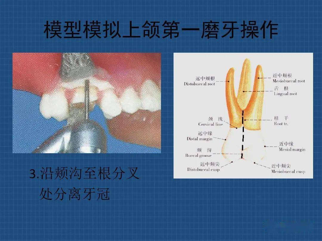 上下颌多根牙分根法