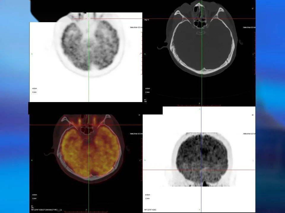 发布高建英主任petct在肿瘤远处转移中的临床应用