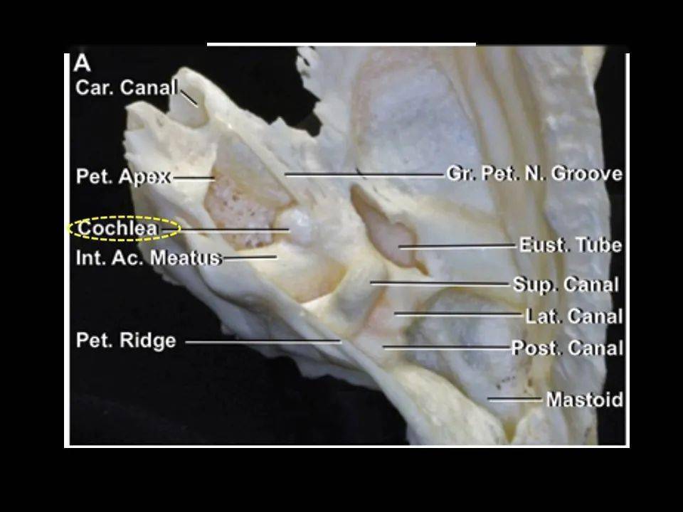 岩骨尖解剖图图片