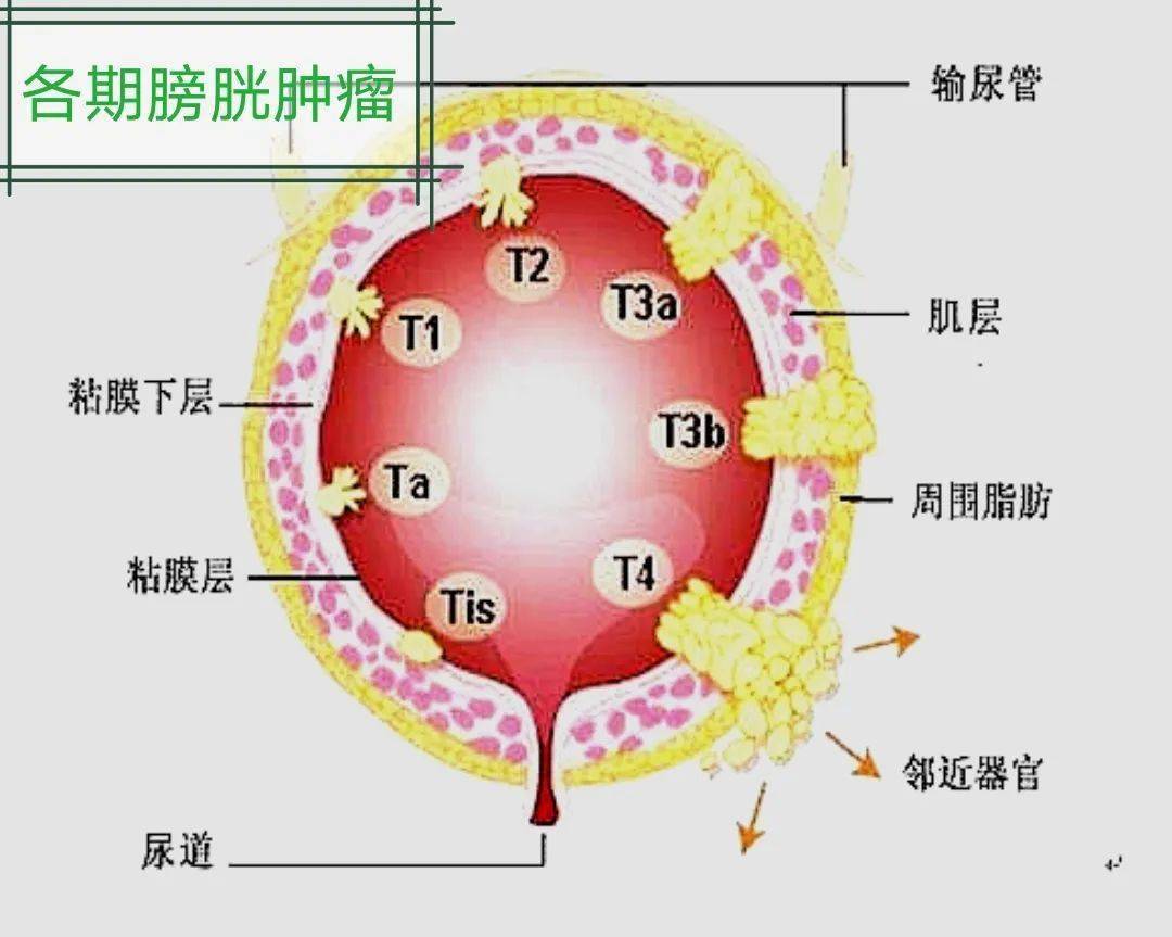 膀胱癌B超图片图片