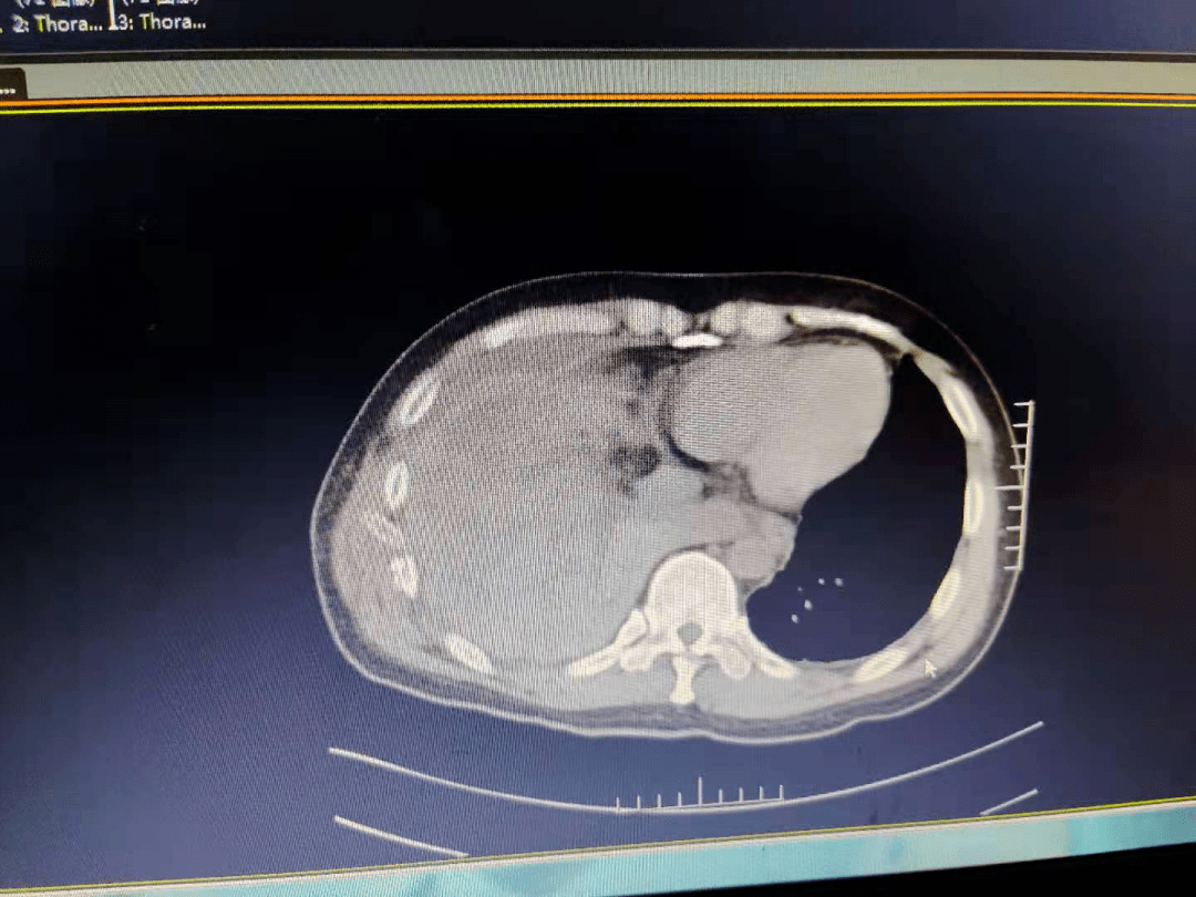 近期,胸外科接診了一名嚴重複合傷,多發肋骨骨折,胸廓畸形的患者薛