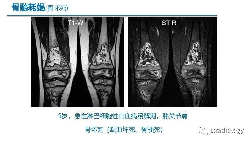 黄骨髓红骨髓图片