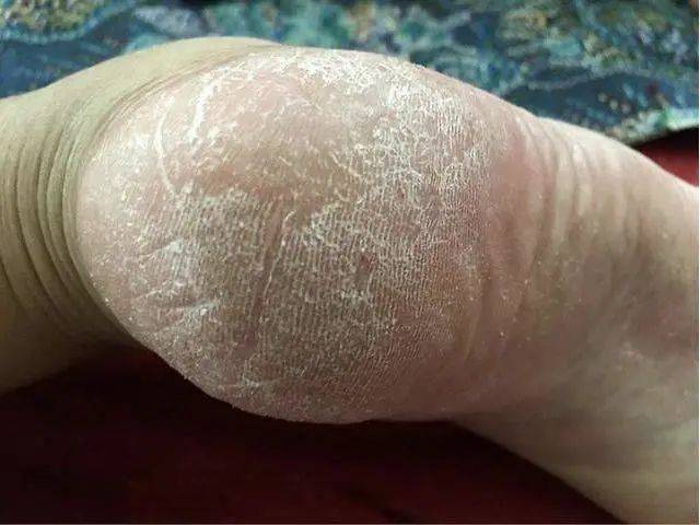 脚上长出的老茧又干又硬怎么办教你一招让你的脚恢复白嫩
