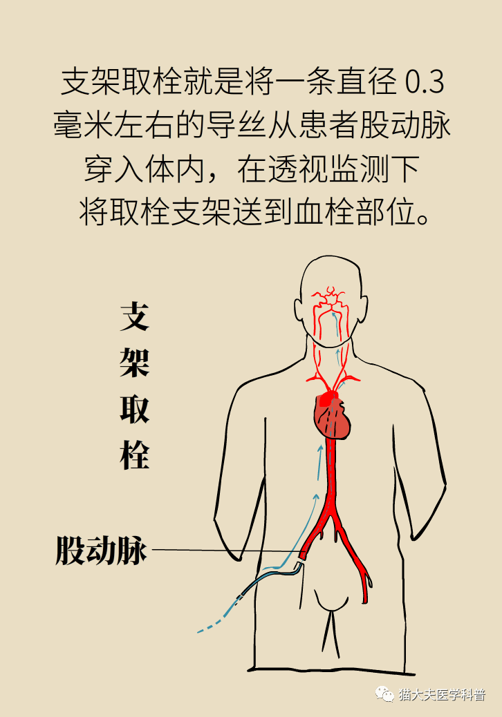 左右股动脉位置图片