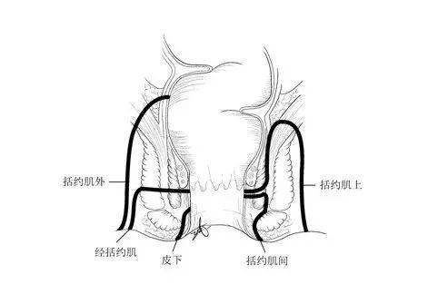 肛瘘如何分类?又有哪些需要进行手术治疗?