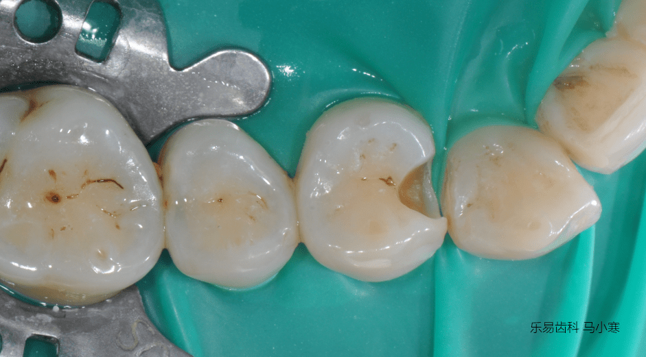 成牙本质细胞突图片
