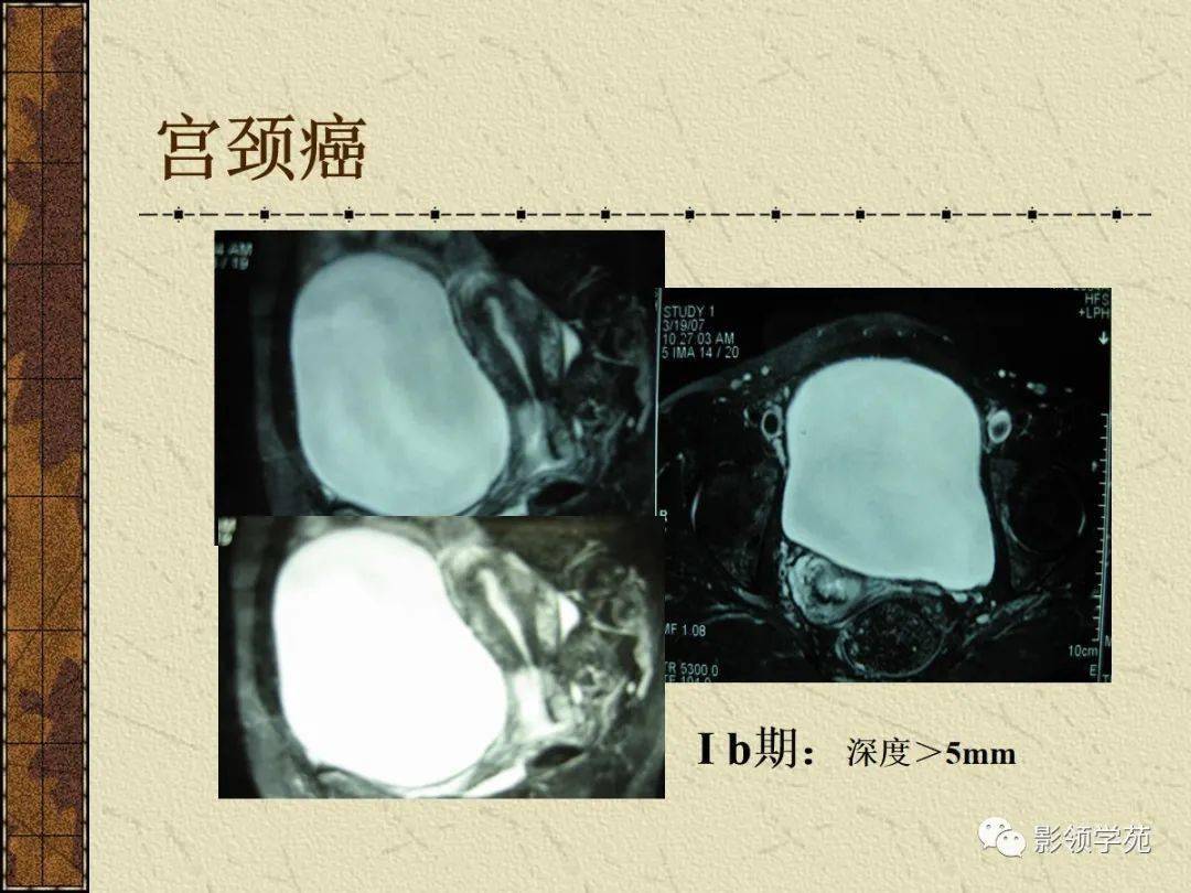 女性盆腔病變的mri診斷