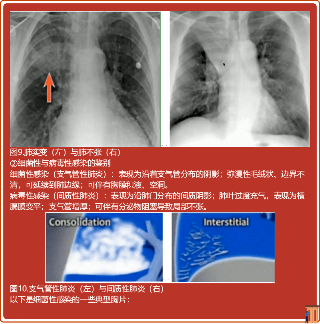 读完此文,终于会看儿童胸片了