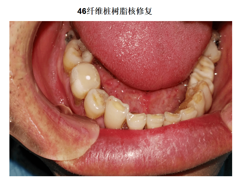 【病例】46重度弯曲根管治疗 纤维桩树脂核 全瓷冠修复