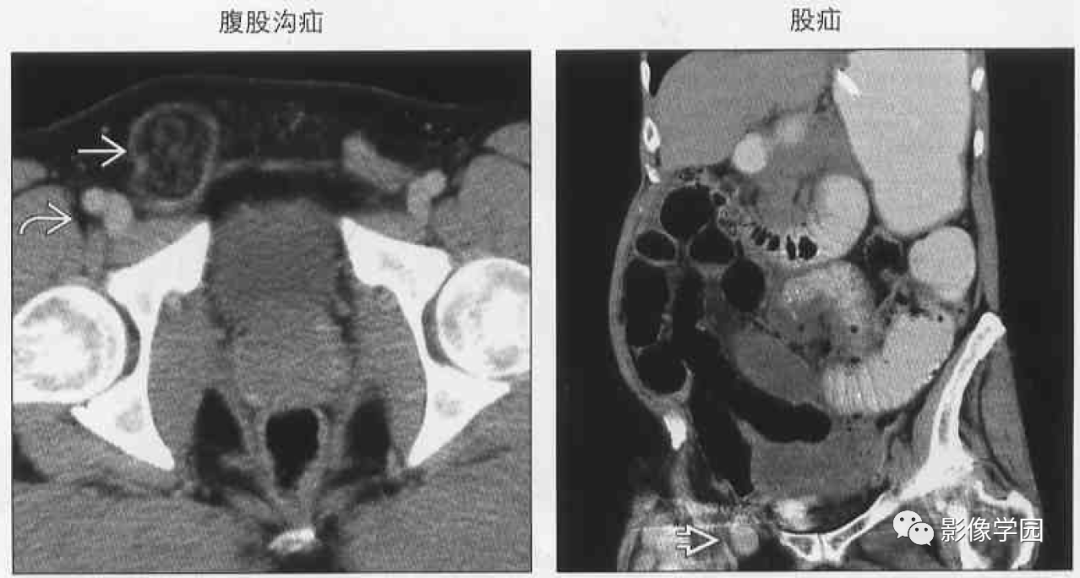 (左图)轴位cect显示腹 股沟疝疝囊内仅包含脂 肪组织,疝囊位于耻骨