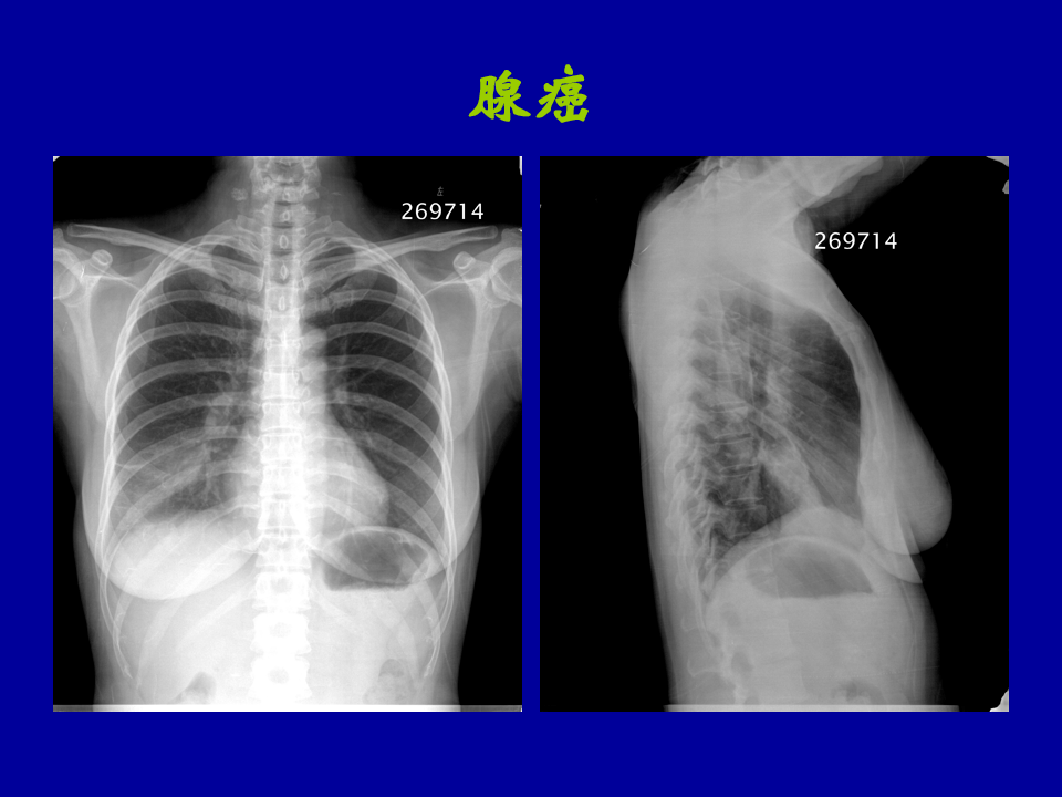 肺部大片阴影影像诊断