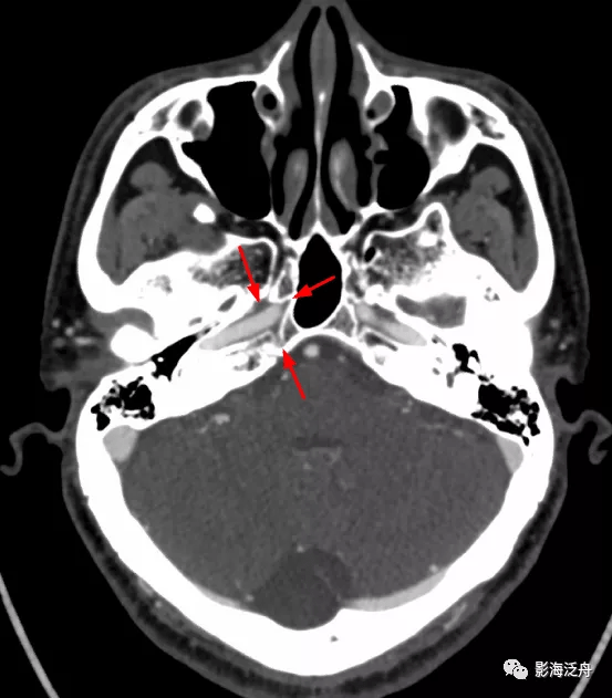 超实用的颈内动脉cta分段