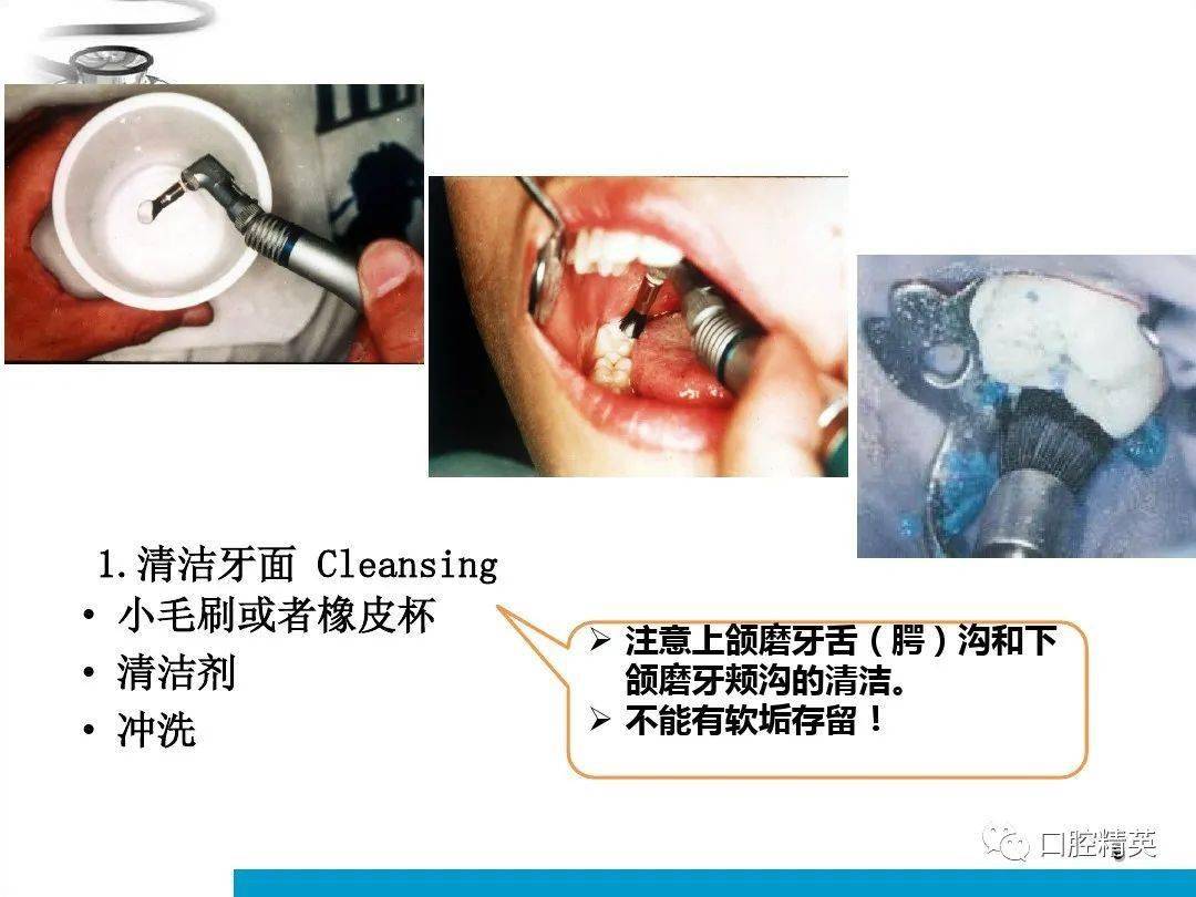 窩溝封閉操作步驟