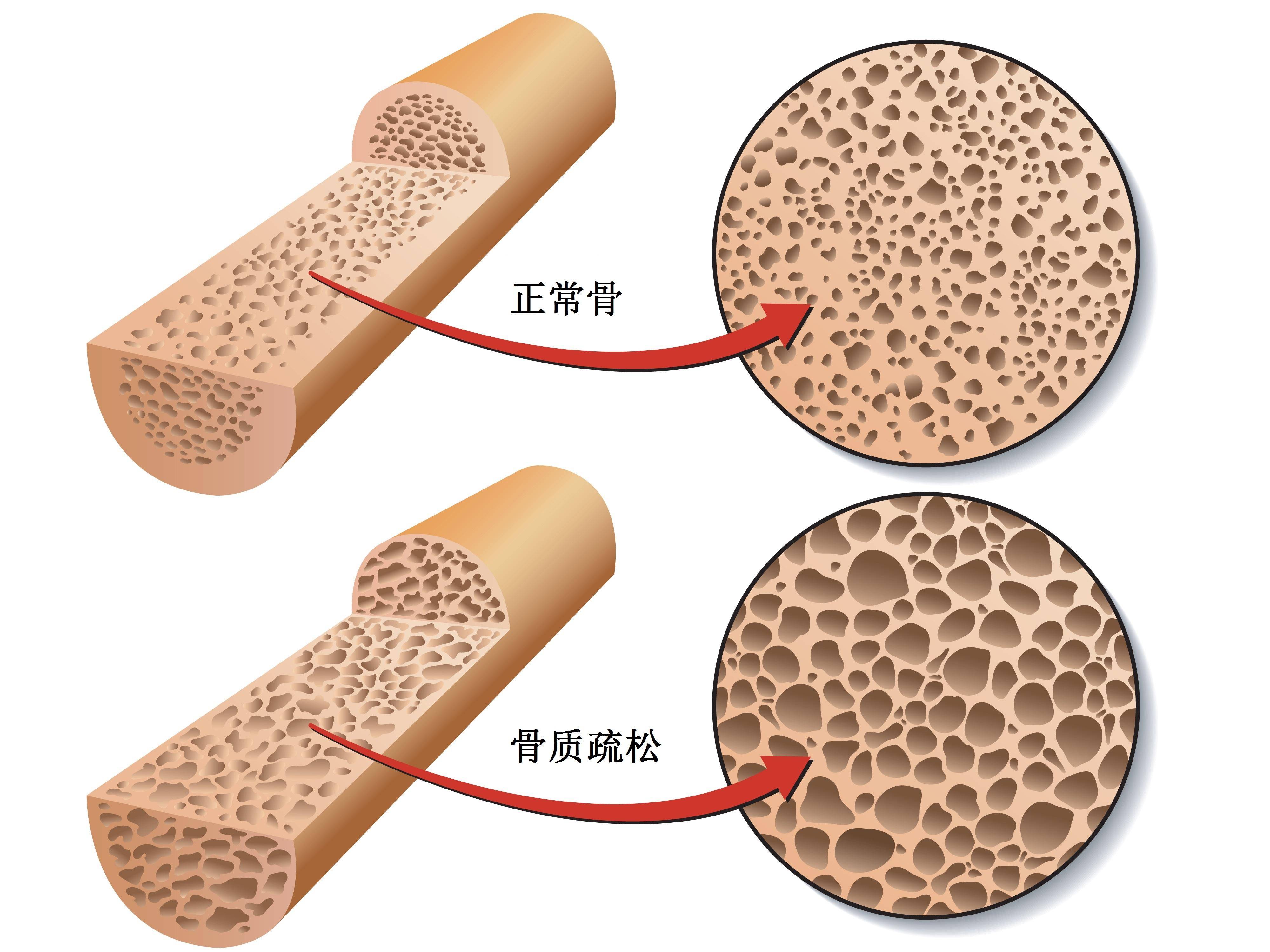 如果没有它,钙离子就无法被骨骼吸收,从而出现骨质疏松症状