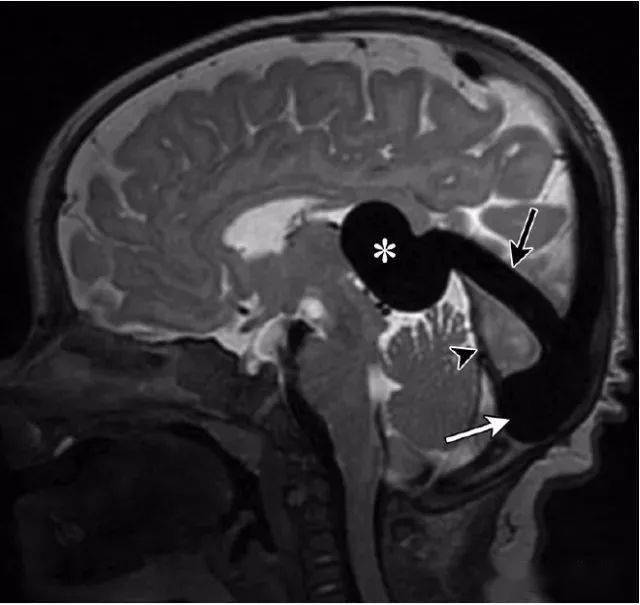 大脑中线处常见的25种疾病