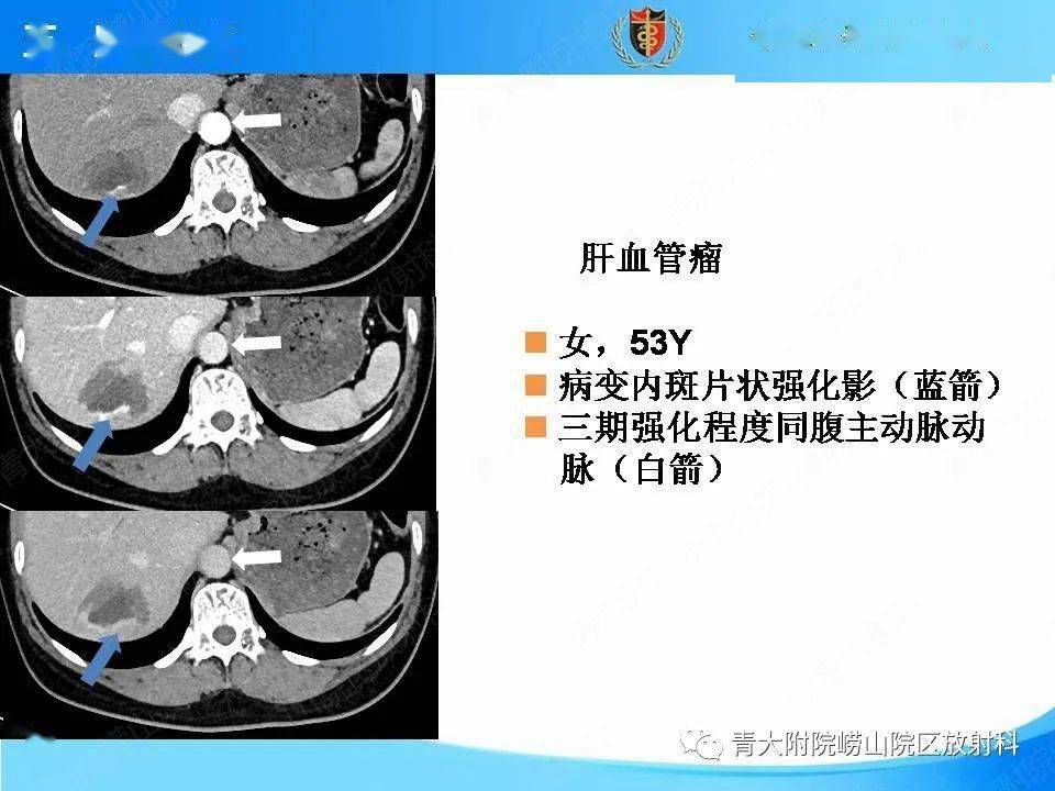 異常改變;病理診斷:符合局灶性結節增生(focal nodularhyperplasia