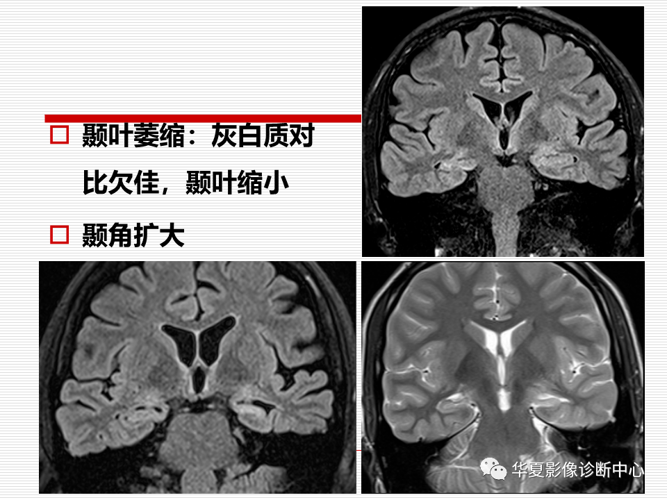 关于海马硬化的影像诊断