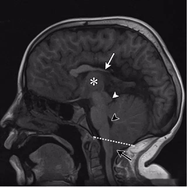 矢狀位t1wi圖像所示小腦扁桃體(黑色箭頭)下疝到椎管內,低於枕骨大孔