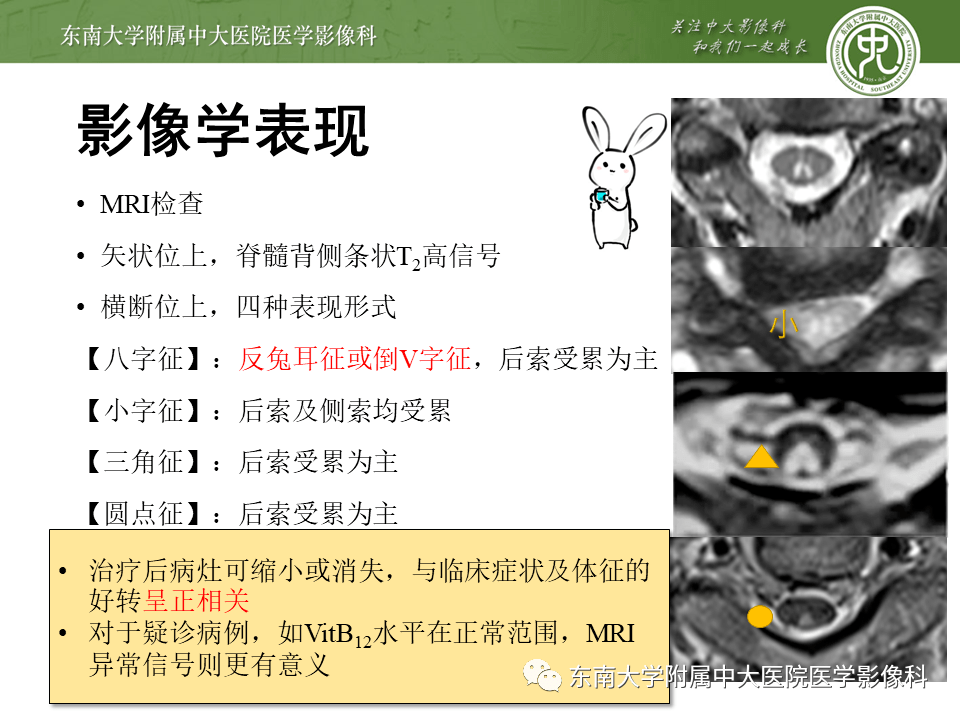 脊髓亚急性联合变性