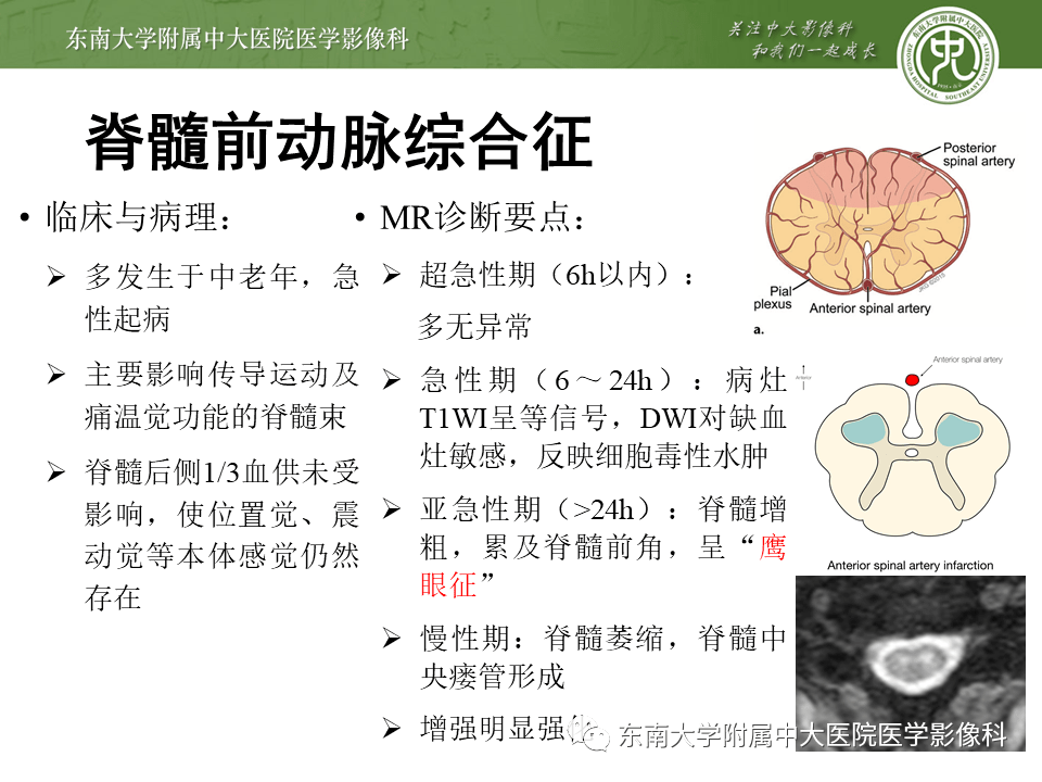 脊髓亚急性联合变性