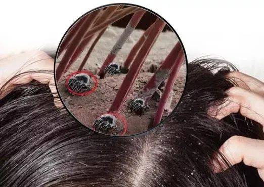 头皮上扣下来的白泥竟然是它别再傻傻不知道了