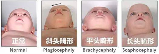 还在给宝宝睡头型小心睡成头颅畸形后悔终生