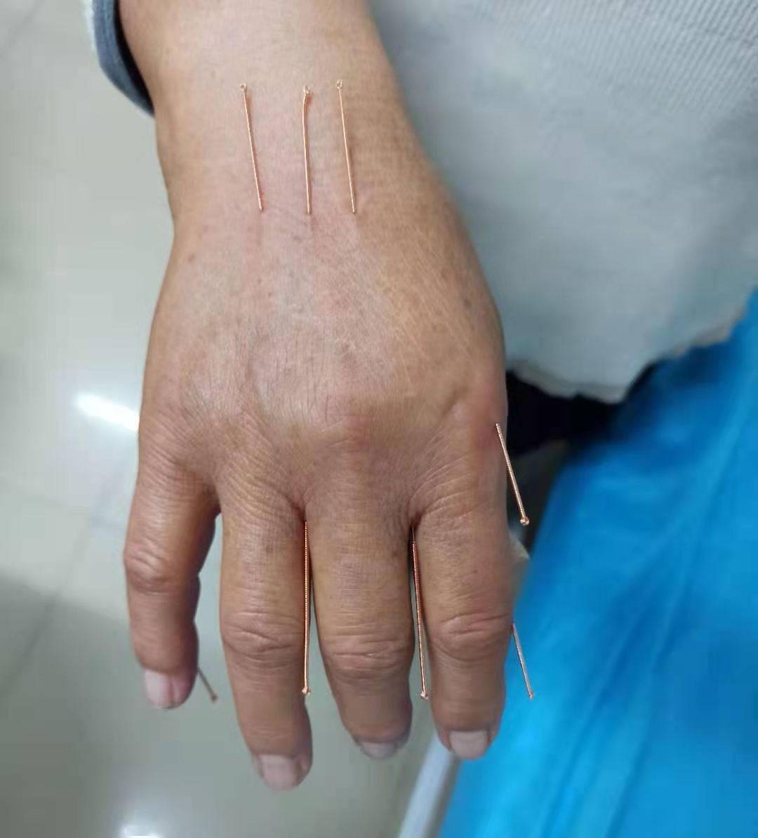 扶阳针法经方六诊后肩袖撕裂伤颈椎间盘突出好了