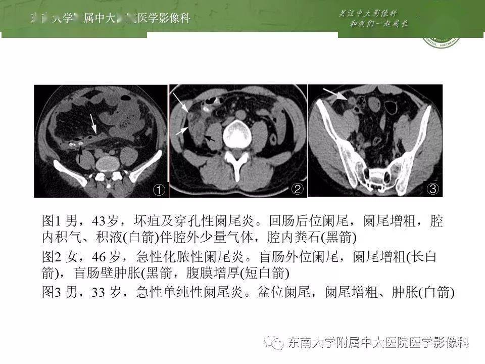 原发性肠脂垂炎