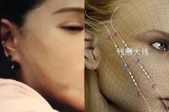 伊能静做了线雕抗衰然后跟大家说做的是热玛吉?