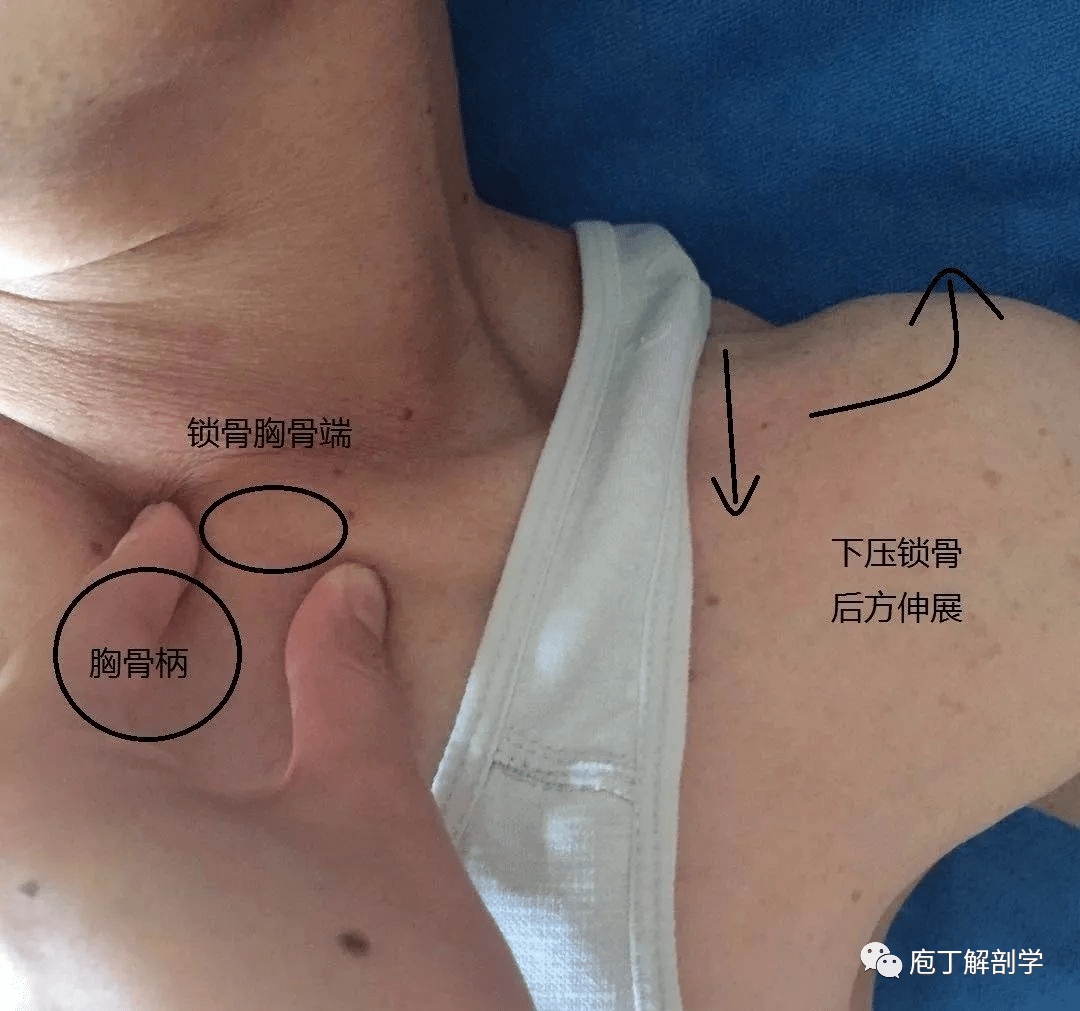 ▼前胸锁韧带用一只手固定病患的锁骨肩峰端,让肩峰沿着锁骨的曲线