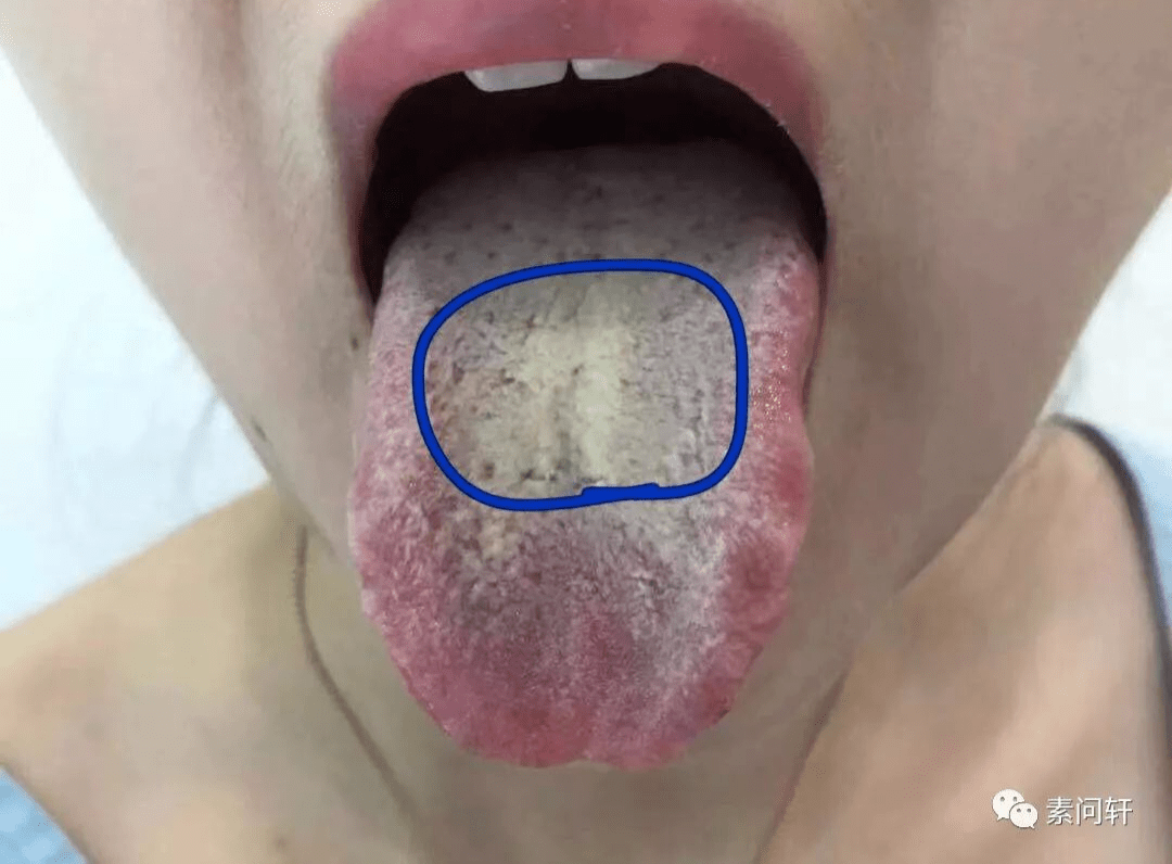 舌头有裂纹就是肾精亏虚？教你认识4种裂纹舌，简单一招修复它 - 哔哩哔哩