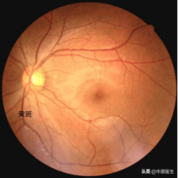 进一步散瞳检查眼底时,发现黄斑区视网膜缺血,呈现樱桃一样的红色.