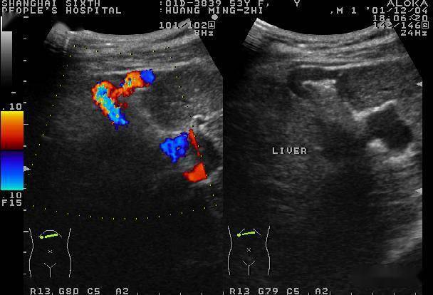 圖3-1-12 肝硬化,門靜脈增寬圖3-1-11 肝硬化,門靜脈頻譜平坦圖3-1-10