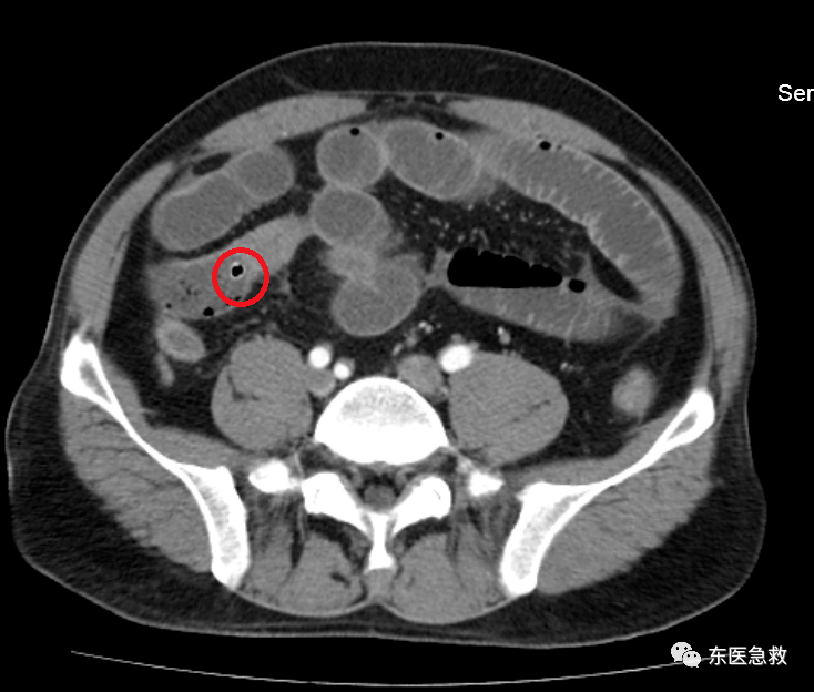 在ct图像上,医生发现了一个一个的小黑点,考虑金叔叔应该是小肠穿孔