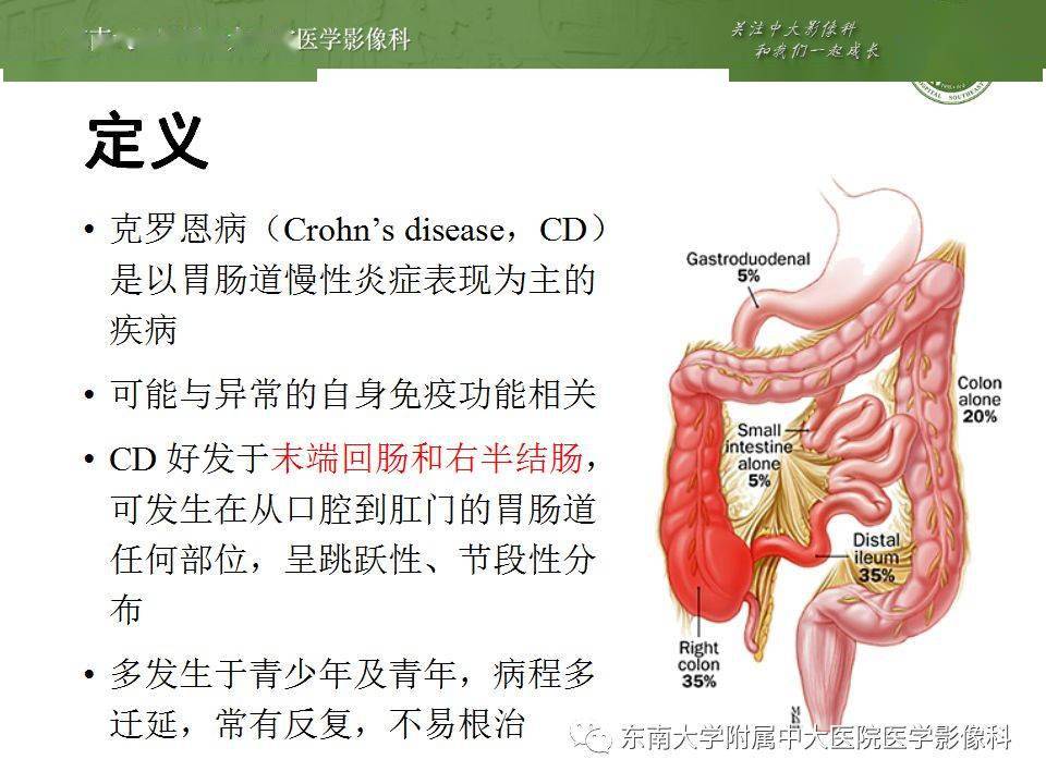 肠管丨右半结肠克罗恩病