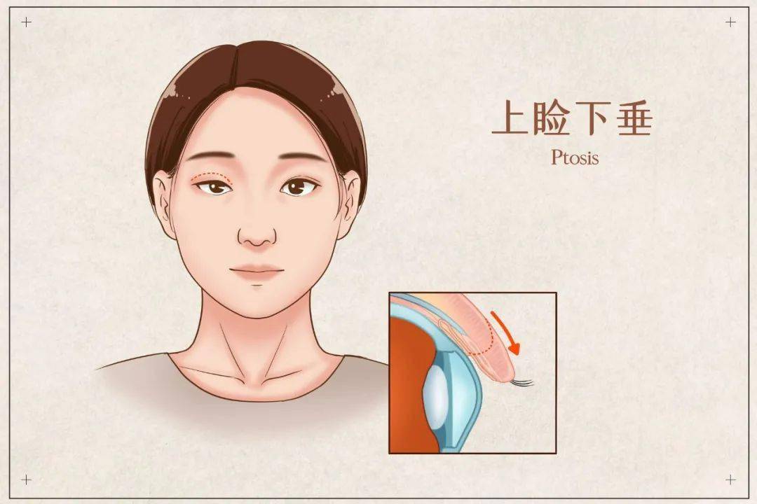 宜兴一女子突发眼睑下垂,到医院一查,竟然是脑动脉瘤!