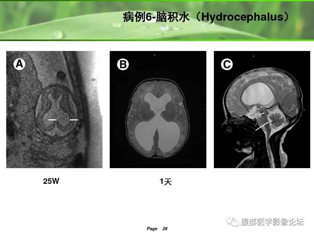 建議收藏胎兒mri正常表現及常見病變影像