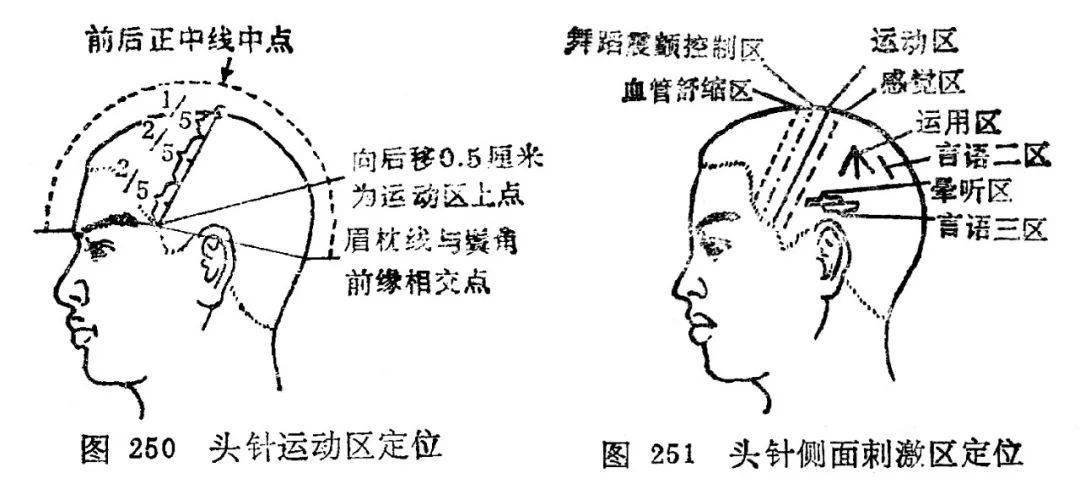 头针定位虚拟现实技术:虚拟现实技术中的视运动训练对动作处理系统的