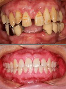 【科普长廊】牙龈增生与降压药有什么关系?