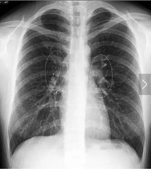 胸腔ct正常图片图片