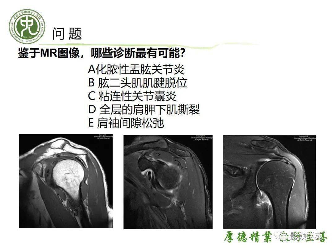 粘连性肩关节囊炎