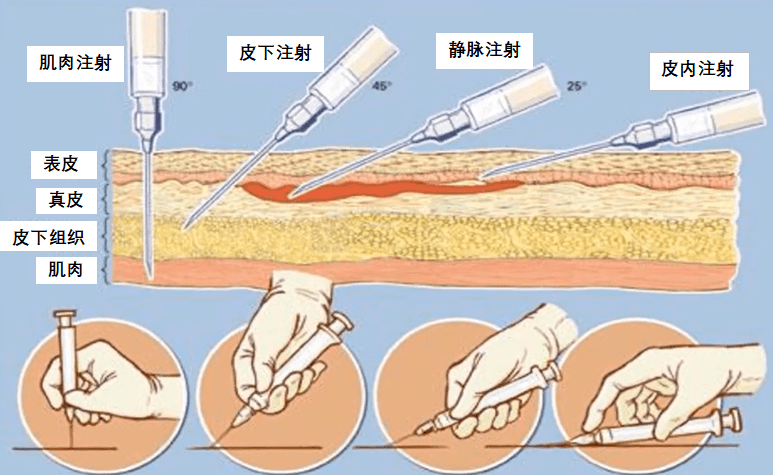 古代没有注射器，人们是怎么打针的？ 药物