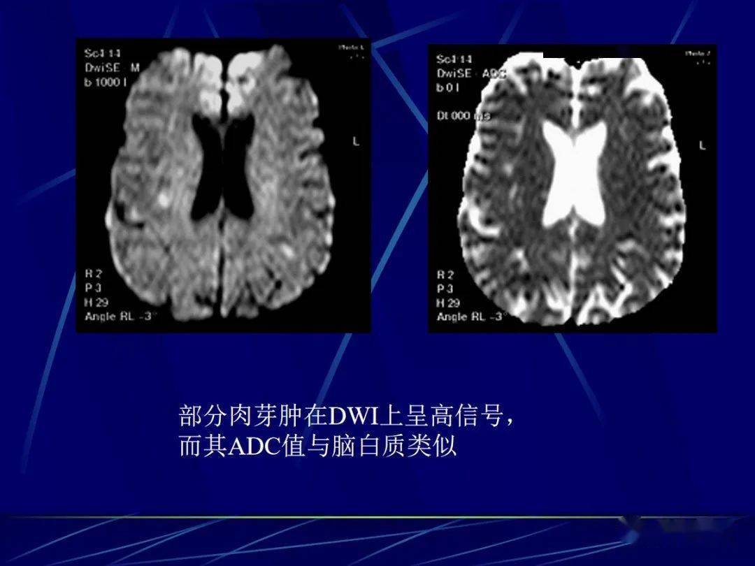 頭顱mri中不同序列dwi和adc的區別