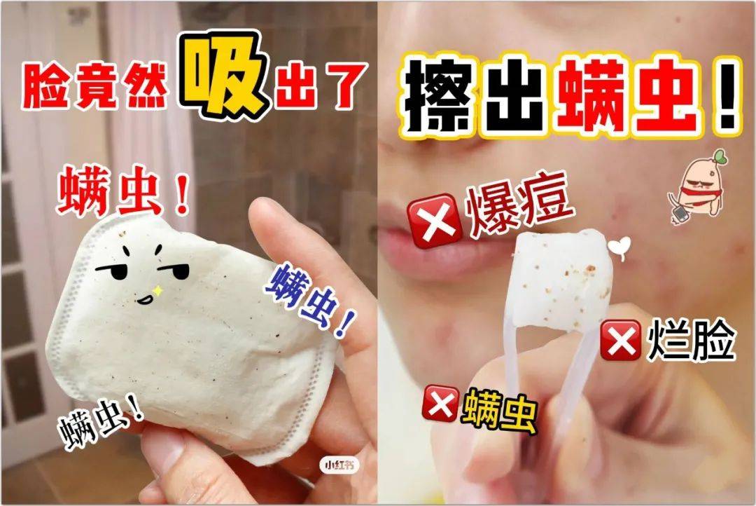 有些螨虫寄生在面部的皮脂腺中,没多久就会长出好多螨虫痘和黑头